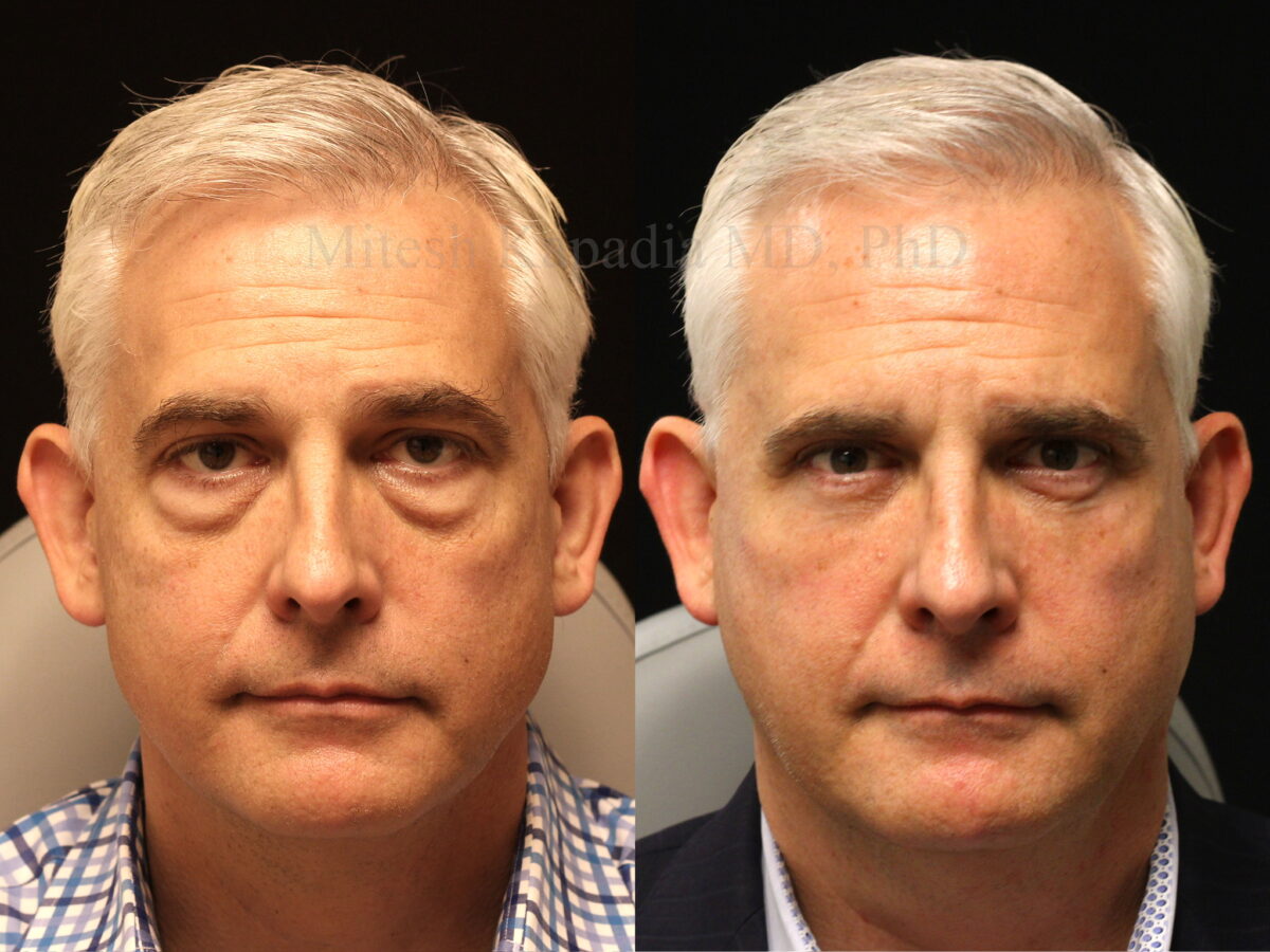 Before and 4 months after upper and lower blepharoplasty surgery with