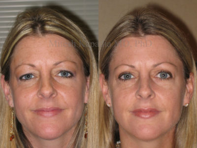Woman in her late 30s shown to display a younger and more awake appearance after upper eyelid surgery