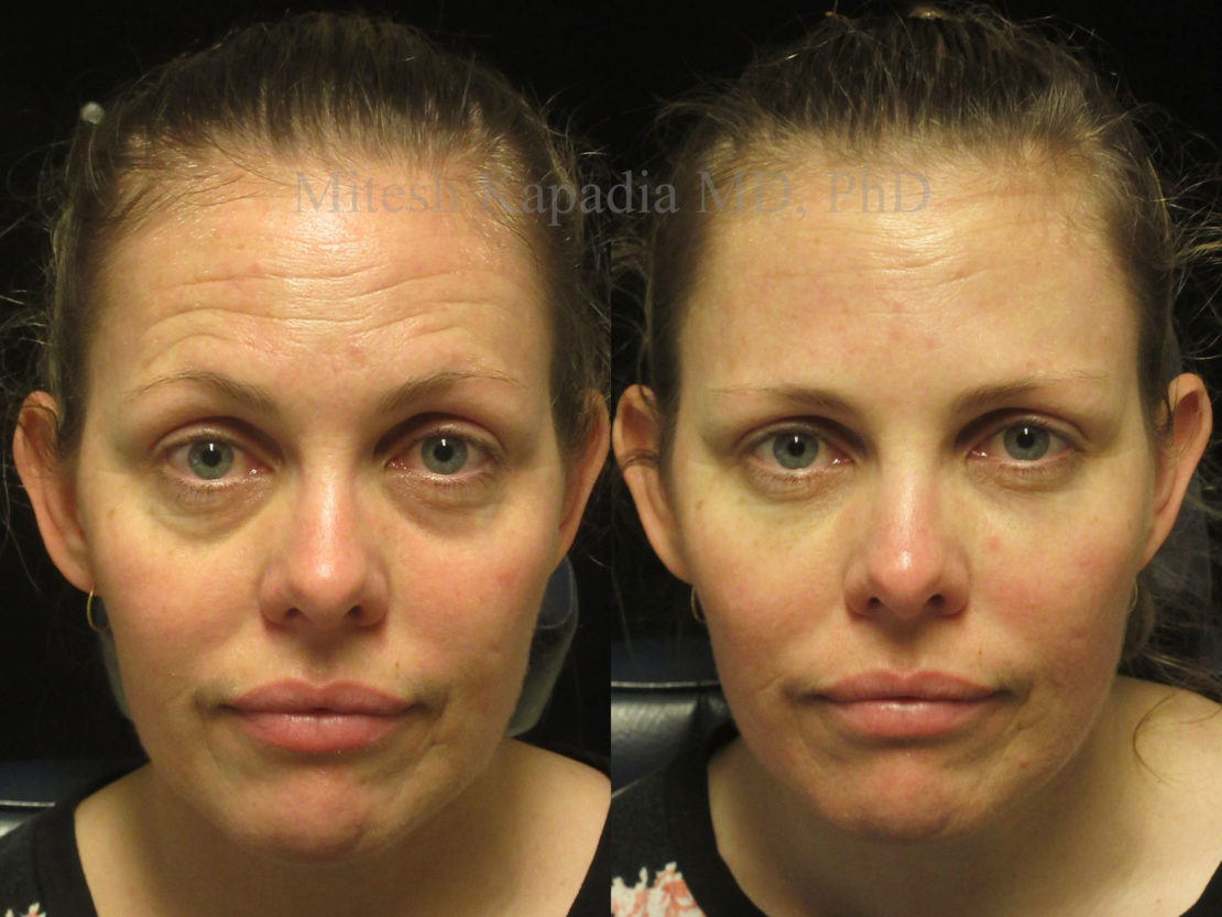 Woman in her 30s before and after lower eyelid filler injections and Botox, revealing less reduced undereye shadowing and a more youthful facial appearance