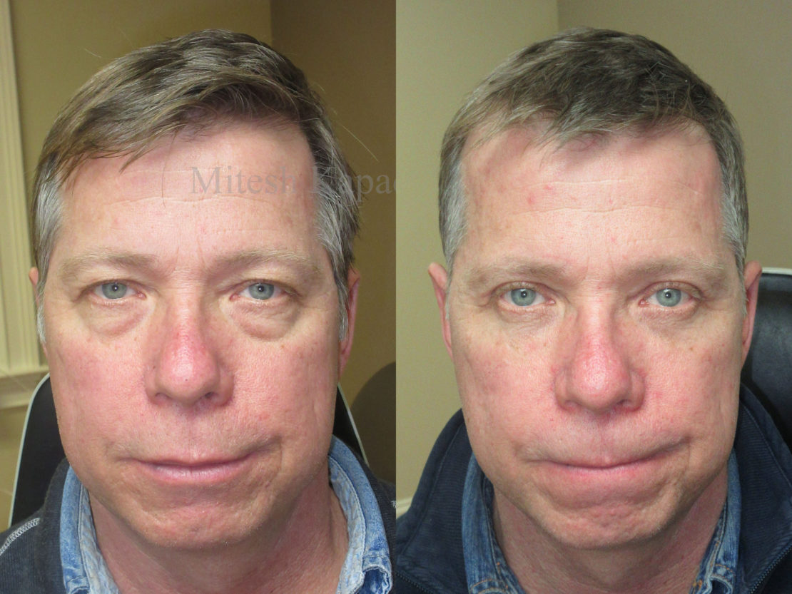 Man in his late 50s before and after upper and lower eyelid surgery, with undereye fillers after his procedure. This reveals a more youthful, less tired appearance