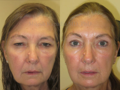 Woman in her early 60s before and after ptosis repair and upper eyelid surgery, revealing improved eyelid symmetry and a more awake appearance