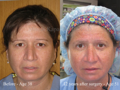 Woman in her early 50s who had upper eyelid surgery in her late 30s, showing lasting results