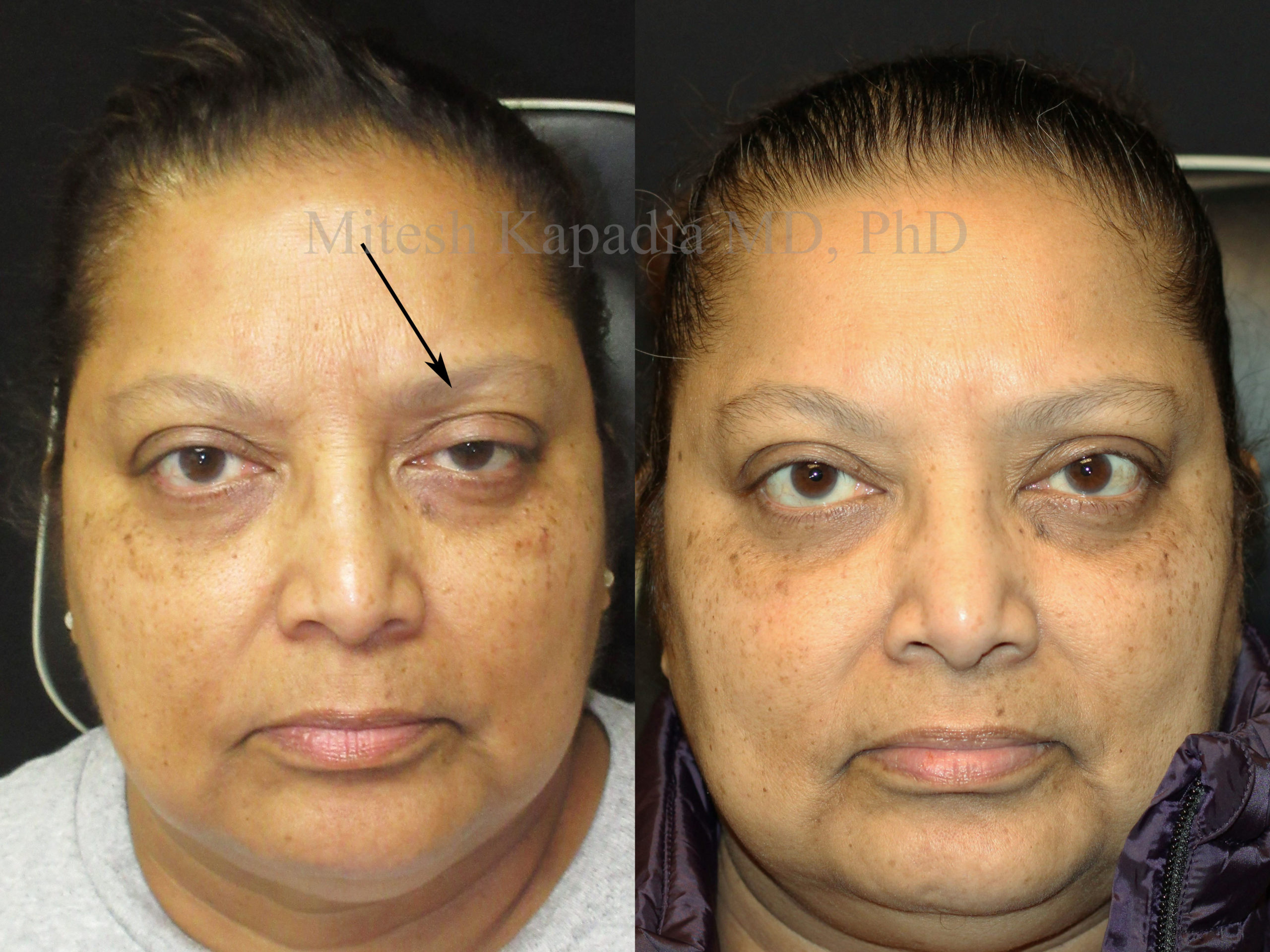 Before And After Ptosis Repair And Eyelid Retraction Surgery Photos Boston Eyelids 