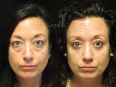 Woman in her mid 30s before and after lower eyelid surgery, displaying a natural, rejuvenated appearance