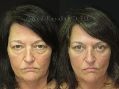 Woman in her late 40s appears rejuvenated after upper and lower eyelid surgery
