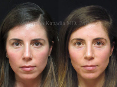 Woman in her mid-30s before and after upper eyelid surgery. This patient only required a subtle change that made it easier for her to wear eye make up