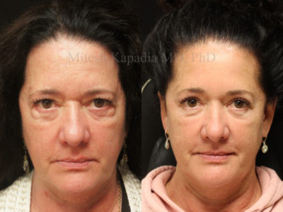 Woman in her late 50s before and after upper and lower eyelid surgery, with undereye filler injections done after her procedure, giving her a less tired, more youthful look