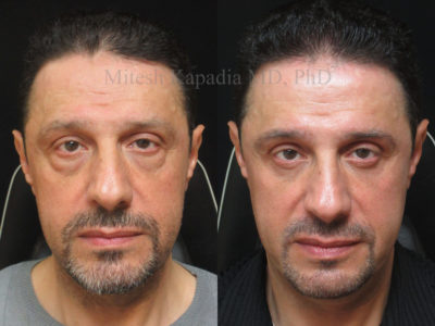 Man in his early 50s before and after lower eyelid surgery appearing more youthful and less tired six months after his procedure