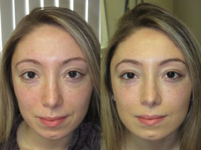 Woman in her 20s before and after lower eyelid and midface fillers, decreasing the appearance of undereye puffiness