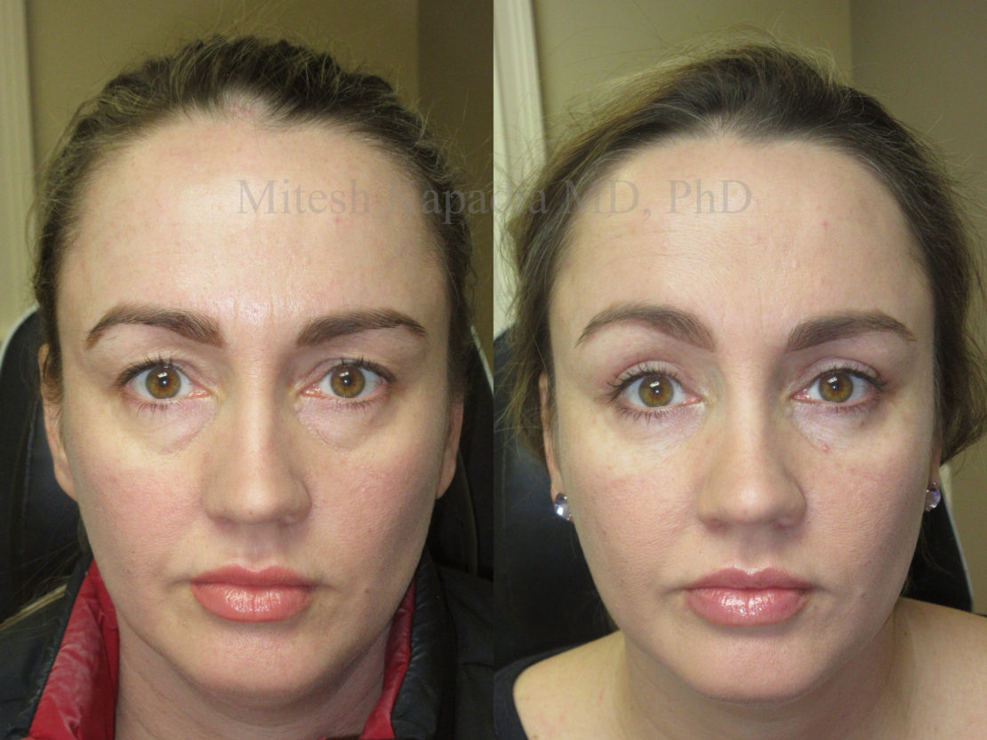 Female in her late 30s revealing a more awake look after upper and lower eyelid surgery