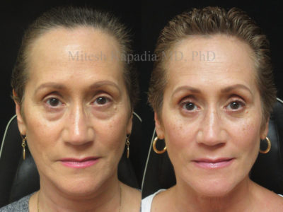 Woman in her mid 50s before and after lower eyelid surgery, showing a refreshed, less tired appearance