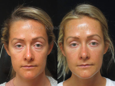 Woman in her mid-30s before and after lower eyelid and midface filler injections, greatly reducing the appearance of eye bags, leaving her with a well rested, refreshed look