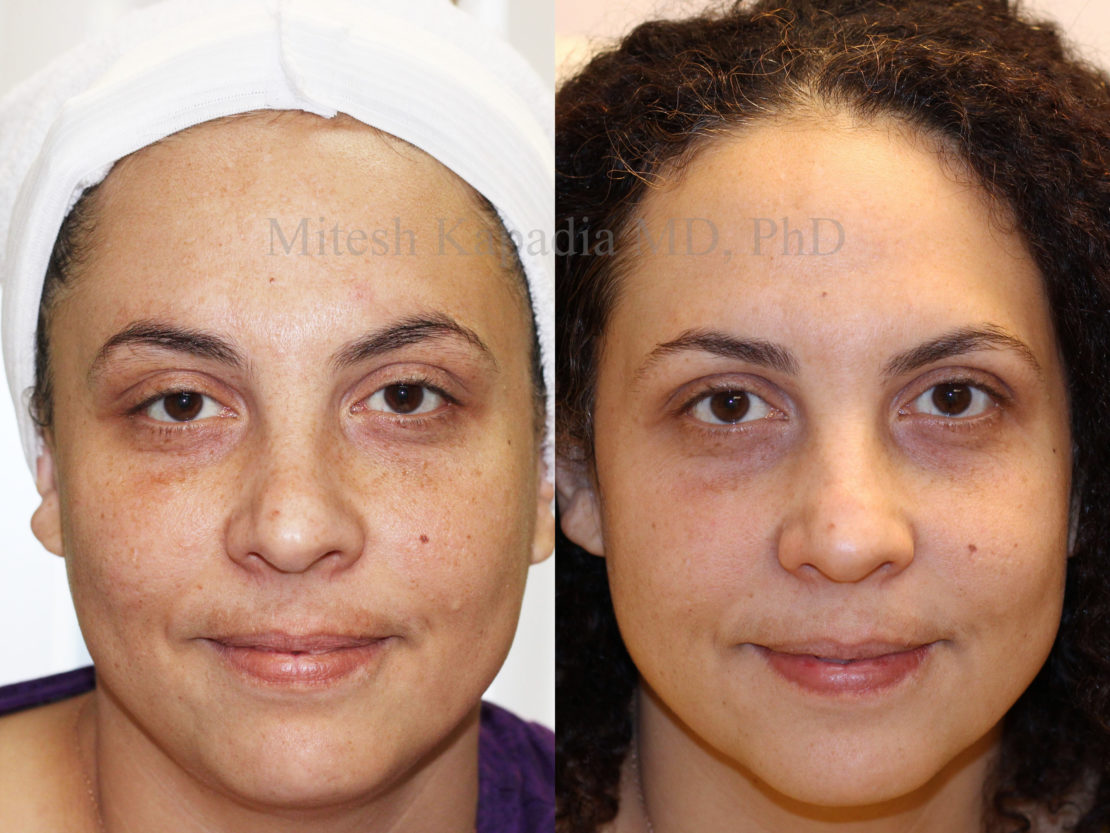 Woman in her early 40s before and six weeks after a VI peel, showing a great reduction in hyperpigmentation, leaving her with vibrant and more even-toned skin