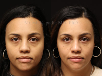 Woman in her early 40s before and after midface and lower eyelid filler injections, leaving her with a smoother transition from lower eyelid to cheek, giving her a refreshed look