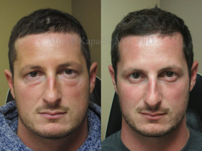Man in his early 30s before and after lower eyelid surgery to remove his undereye bags, leaving him with a well rested, refreshed appearance
