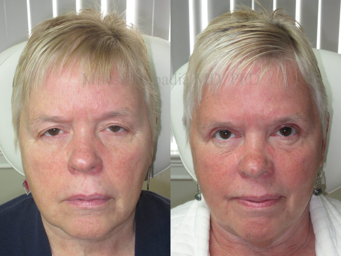 Woman in her 60s before and after ptosis repair and upper eyelid surgery, giving her a refreshed appearance and the ability to see better
