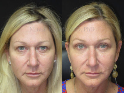 Woman in her early 50s before and after upper eyelid surgery, as well as a Botox brow lift and lower eyelid fillers. These procedures leave her looking vibrant, more youthful and well rested