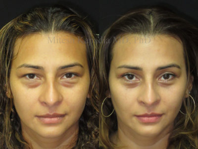 Woman in her mid-30s before and after upper and lower eyelid surgery, displaying a more youthful, less tired look