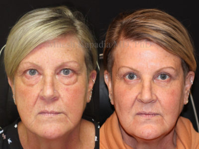 Woman in her mid-50s before and after upper and lower eyelid surgery, and in addition, lower eyelid fillers. This displays a smoother, more youthful and refreshed appearance