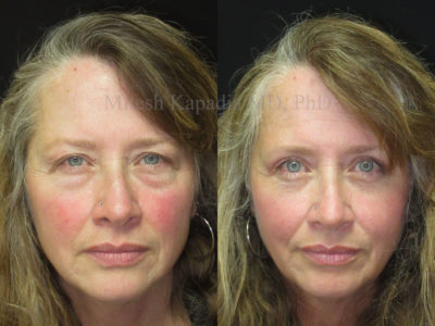 Woman in her late 50s before and after upper and lower eyelid surgery, showing diminished under bags, giving her a refreshed, more youthful look