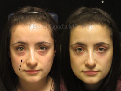 Woman in her late 20s before and after lower eyelid filler, displaying reduced under eye puffiness and a refreshed, less tired look