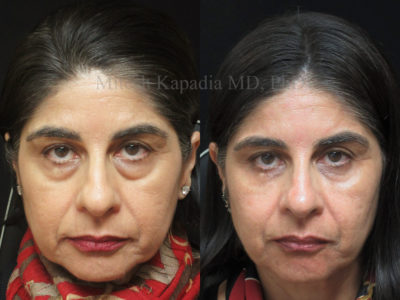 Woman in her mid-50s before and after lower eyelid surgery with undereye filler injections done after her procedure, showing a rejuvenated and more youthful appearance