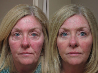 Woman in her 50s before and after revision lower eyelid surgery. This patient had two other surgeries with another doctor, but still had excess fat pats in the outer aspects of both of her eyes. After this procedure, she appears more youthful, and the undereye puffiness is diminished