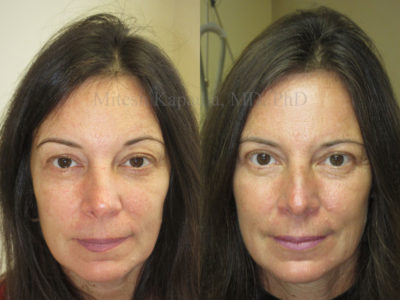 Woman in her late 40s before and after upper eyelid surgery, revealing a refreshed and more symmetrical appearance