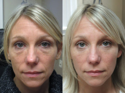 Woman in her 40s before and after lower eyelid surgery, leaving her looking well rested and natural