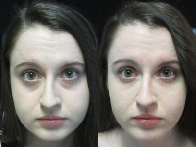 Woman in her 20s before and after lower eyelid filler, resulting in decreased dark circles under the eyes, showing a well rested, less tired look