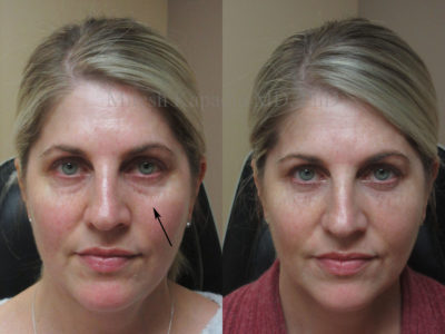 Woman in her early 50s before and after lower eyelid filler injections, showing her mild undereye puffiness greatly decreased, giving her a less tired and refreshed look