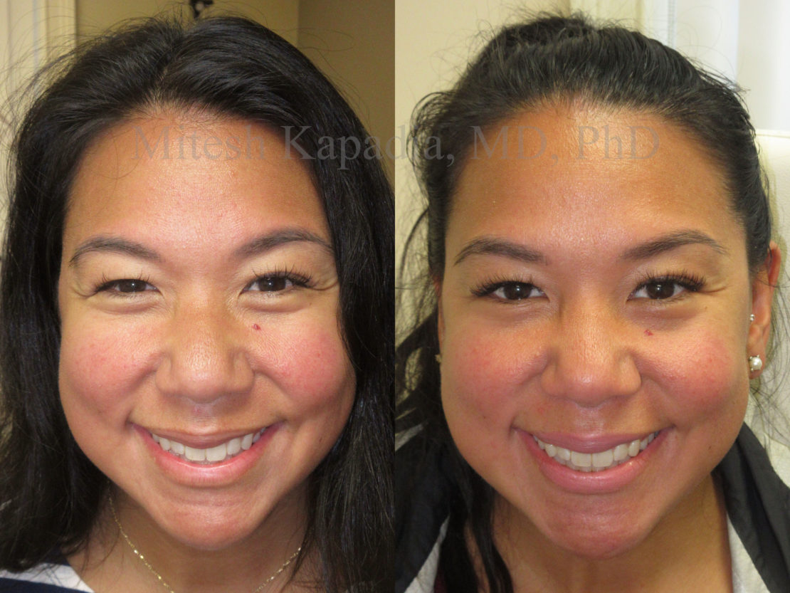 Woman in her 30s before and after being treated with Botox for crows feet and a brow lift. This patient appears with a more symmetrical eye area, as well as reduced wrinkles around the eyes, making them appear larger