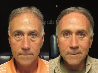 Man in his mid-60s before and after lower eyelid surgery, leaving him with a more awake, refreshed appearance while not looking overdone or unnatural