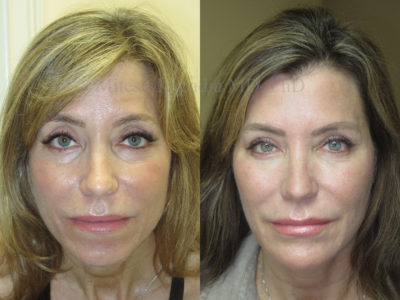 Woman in her early 50s before and after a series of treatments following upper and lower eyelid surgery done by another surgeon. This patient was not completely satisfied with the results of her surgery, so filler was added to the upper eyelids, lower eyelids, cheeks, temples, and nasolabial folds, as well as Botox injections to the forehead. In the after photo, she appears more vibrant, youthful, and refreshed
