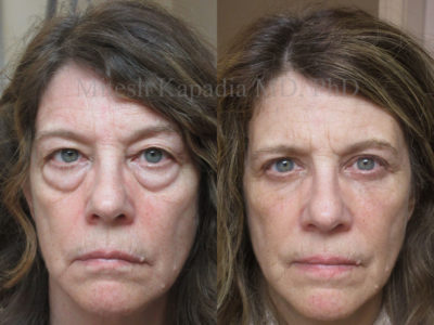 Woman in her 60s before and after upper and lower eyelid surgery, with filler injections added six weeks after surgery, revealing diminished undereye bags and more a youthful, less tired appearance