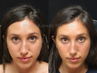 Woman in her late 20s before and after lower eyelid filler, revealing a less tired appearance