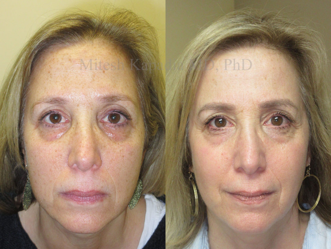 Woman in her late 50s before and after a series of three full face CO2 laser treatments. These treatments not only lessened her hyperpigmentation, they also smoothed out her skin texture, and provided a more evened skin tone