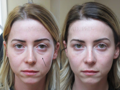 Woman in her early 30s before and after lower eyelid and cheek fillers, which improved the hollowing under her eyes, creating a smoother, and well rested look