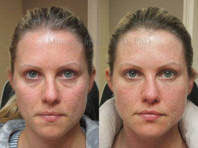 Woman in her mid-30s before and after filler injections to blend the eyelid-cheek junction, alleviating her undereye puffiness and shadowing, leaving her looking refreshed and vibrant