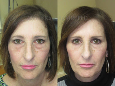 Woman in her 50s before and after upper and lower eyelid surgery, giving her a less tired, more youthful appearance