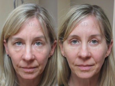 Woman in her late 40s before and after upper and lower eyelid surgery with undereye filler done six weeks after surgery. After her procedures, she appears more youthful and rejuvenated