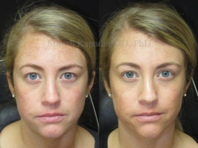 Woman in her early 30s before and after upper eyelid surgery, revealing more of her eyes, making them appear larger and more awake