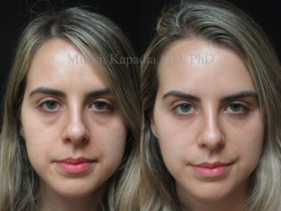 Woman in her late 20s before and after lower eyelid filler injections, showing reduced undereye bags and discoloration, leaving her appearing refreshed