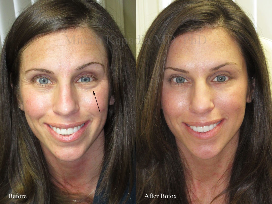 Woman in her 30s before and two weeks after Botox injections, giving her increased symmetry and greatly reduced lines when she smiles