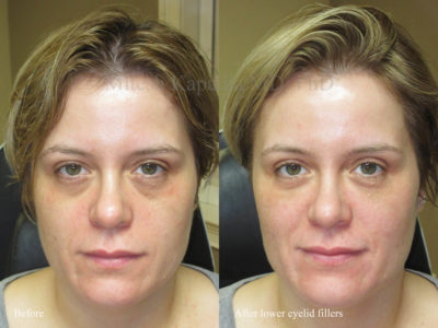 Woman in her early 40s before and after lower eyelid and midface fillers for dark circles under her eyes. After her procedure, she appears less tired and rejuvenated, while still maintaining a natural appearance