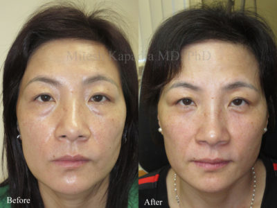 Woman in her late 40s before and after lower eyelid surgery, with undereye fillers added six weeks after surgery. This patient appears less tired with a smoother, more youthful look