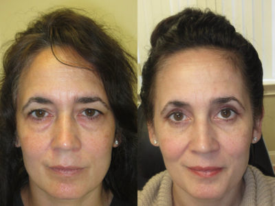 Woman in her mid-40s before and after upper and lower eyelid surgery, revealing a more youthful, more awake and vibrant appearance