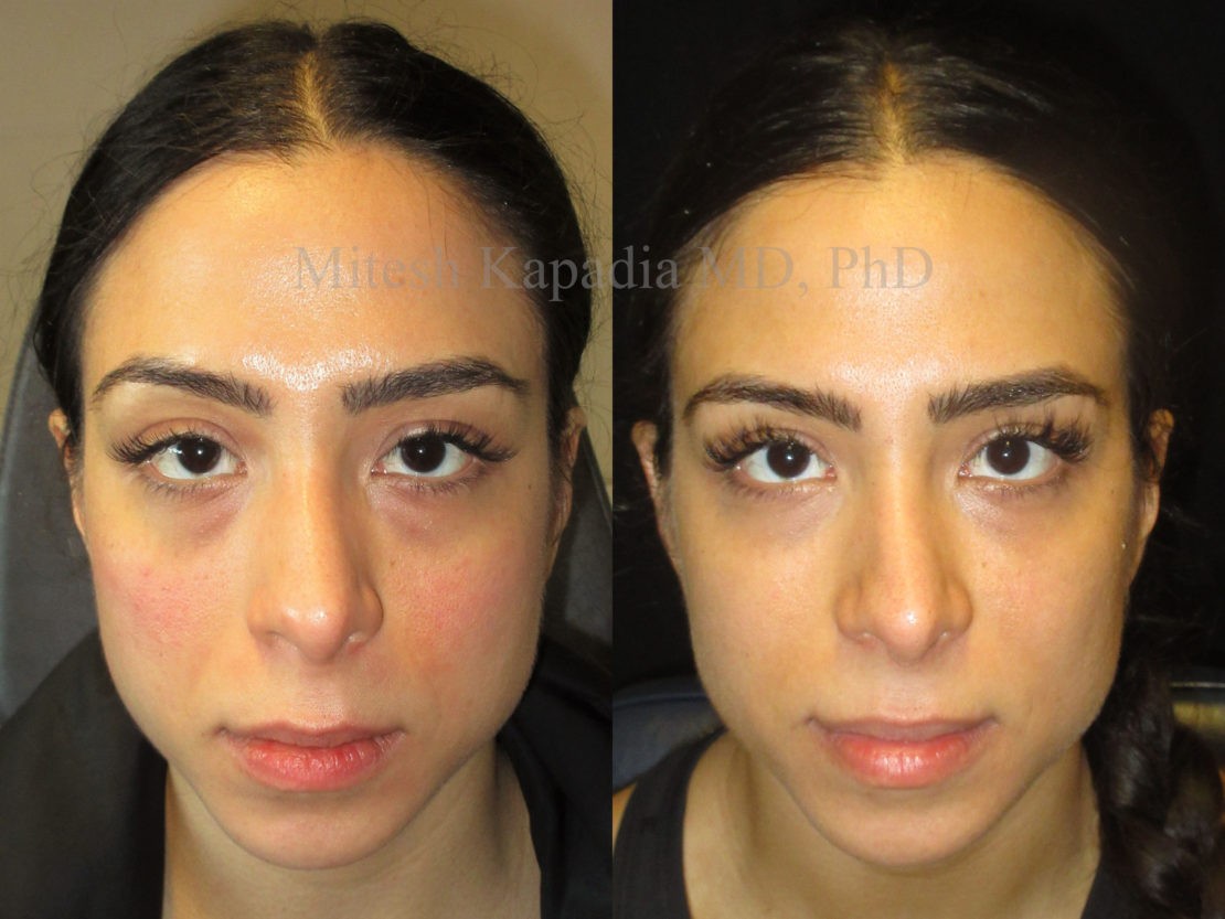 Woman in her 30s before and after lower eyelid, midface, cheek and lip fillers, as well as Botox injections between her eyebrows. These injections were preformed slowly over multiple sessions 2-3 weeks apart. After her procedures, she displays a vibrant, smooth, refreshed look