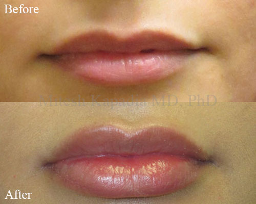 Before and after lip filler injections