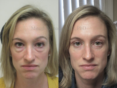 Woman in her early 40s before and after upper and lower eyelid surgery, giving her a more youthful, refreshed appearance